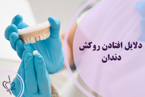 افتادن روکش دندان