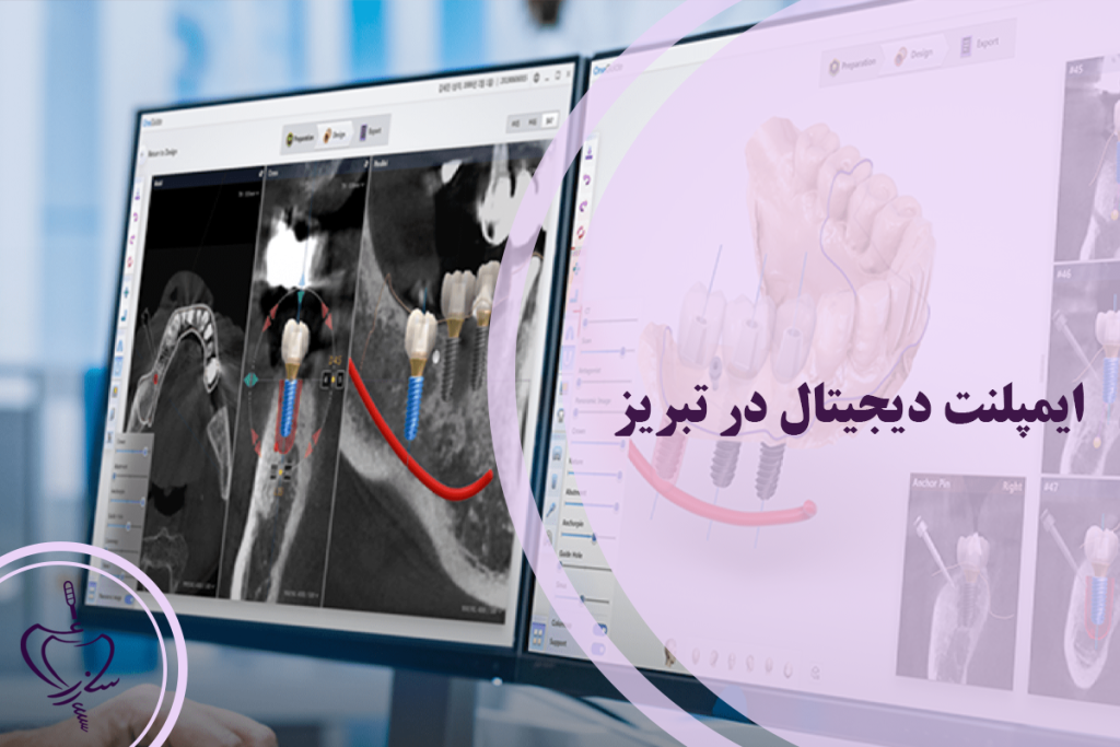 بهترین مرکز ایمپلنت دیجیتال در تبریز
