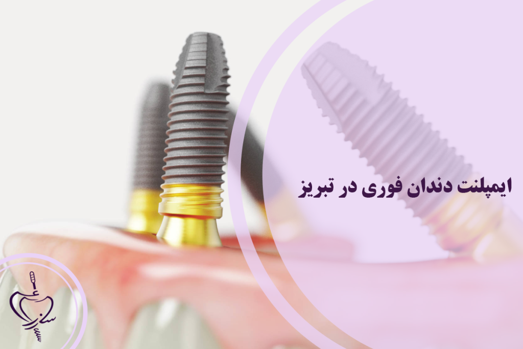 ایمپلنت فوری در تبریز