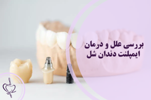ایمپلنت دندان شل