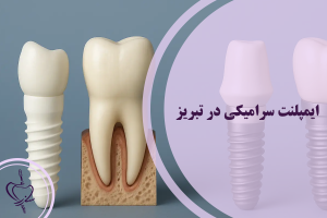 ایمپلنت سرامیکی در تبریز