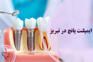 ایمپلنت پانچ در تبریز