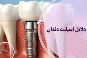 دلایل ایمپلنت دندان