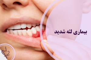 بیماری لثه شدید