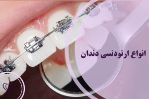 انواع ارتودنسی دندان