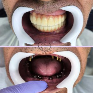 نمونه درمان ایمپلنت دندان در تبریز