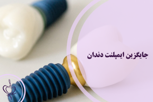 جایگزین‌ ایمپلنت دندان