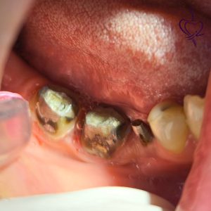 نمونه درمان بهترین متخصص ایمپلنت در تبریز