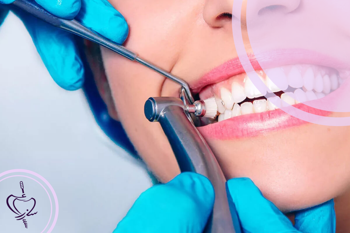 جرمگیری حرفهای در مطب دندانپزشکی