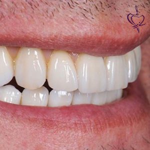 Zirconia-dental-implant-treatment-example
