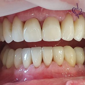 Zirconia-dental-implant-treatment-example-in-Tabriz