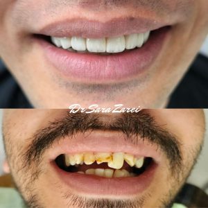 نمونه درمان ایمپلنت دندان زیرکونیا در تبریز