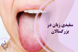 سفیدی زبان در بزرگسالان