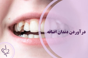 درآوردن دندان اضافه