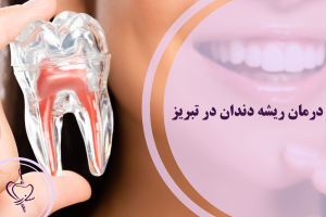 درمان ریشه دندان در تبریز