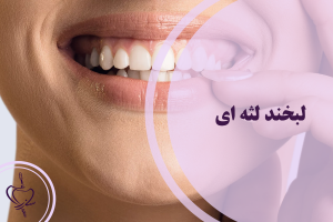 لبخند لثه‌