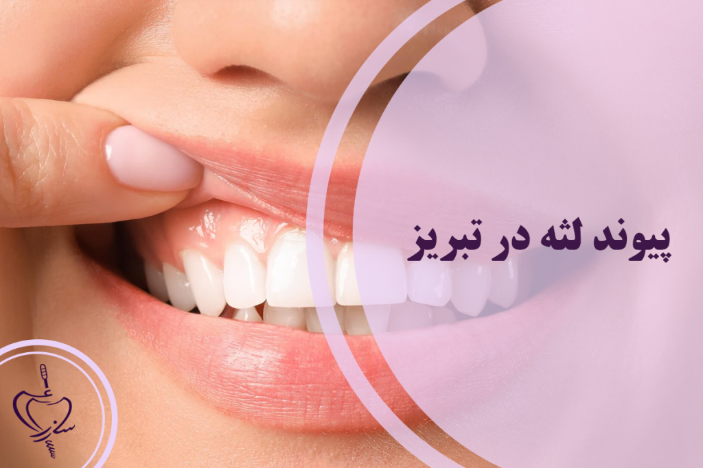 پیوند لثه در تبریز