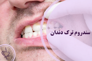 سندروم ترک دندان