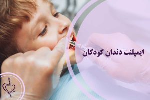 یمپلنت دندان کودکان
