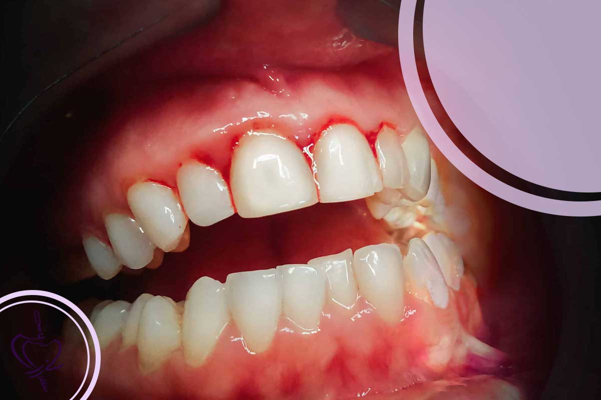 بیماریهای مؤثر بر خونریزی لثه