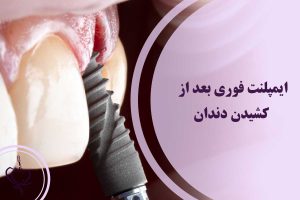 ایمپلنت فوری بعد از کشیدن دندان