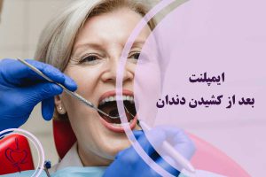 ایمپلنت بعد از کشیدن دندان