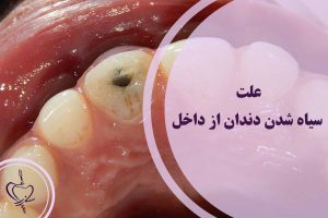 سیاه شدن دندان از داخل