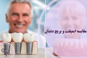مقایسه ایمپلنت و بریج دندان
