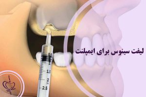 لیفت سینوس برای ایمپلنت