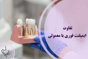 ایمپلنت فوری بهتر است یا معمولی