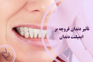 تأثیر دندان قروچه بر ایمپلنت دندان