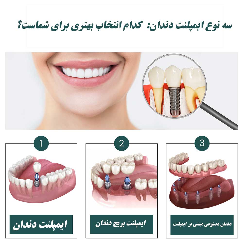 بهترین نوع ایمپلنت