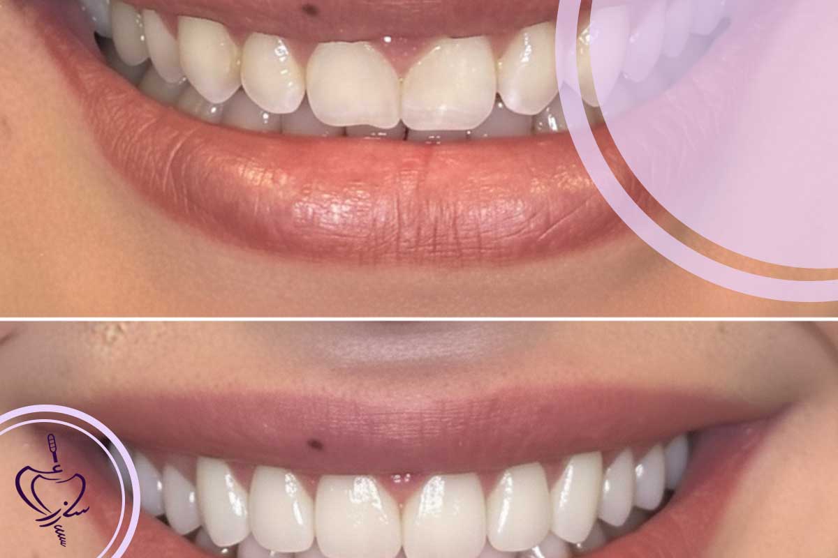 چرا لبخند برخی افراد طبیعی و بینقص است، اما کامپوزیت دندان دیگران مصنوعی به نظر میرسد؟