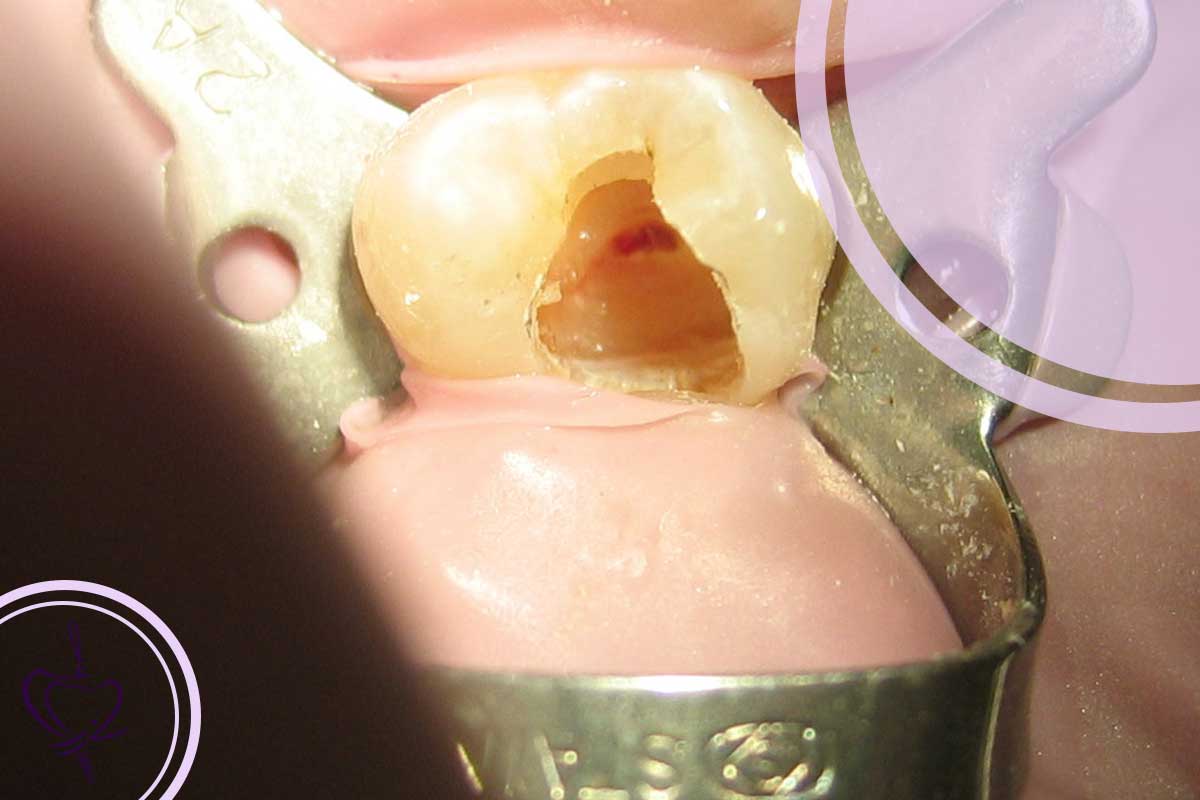 سفر به مرکز دندان: مراحل یک درمان ریشه موفق در تبریز چگونه است؟