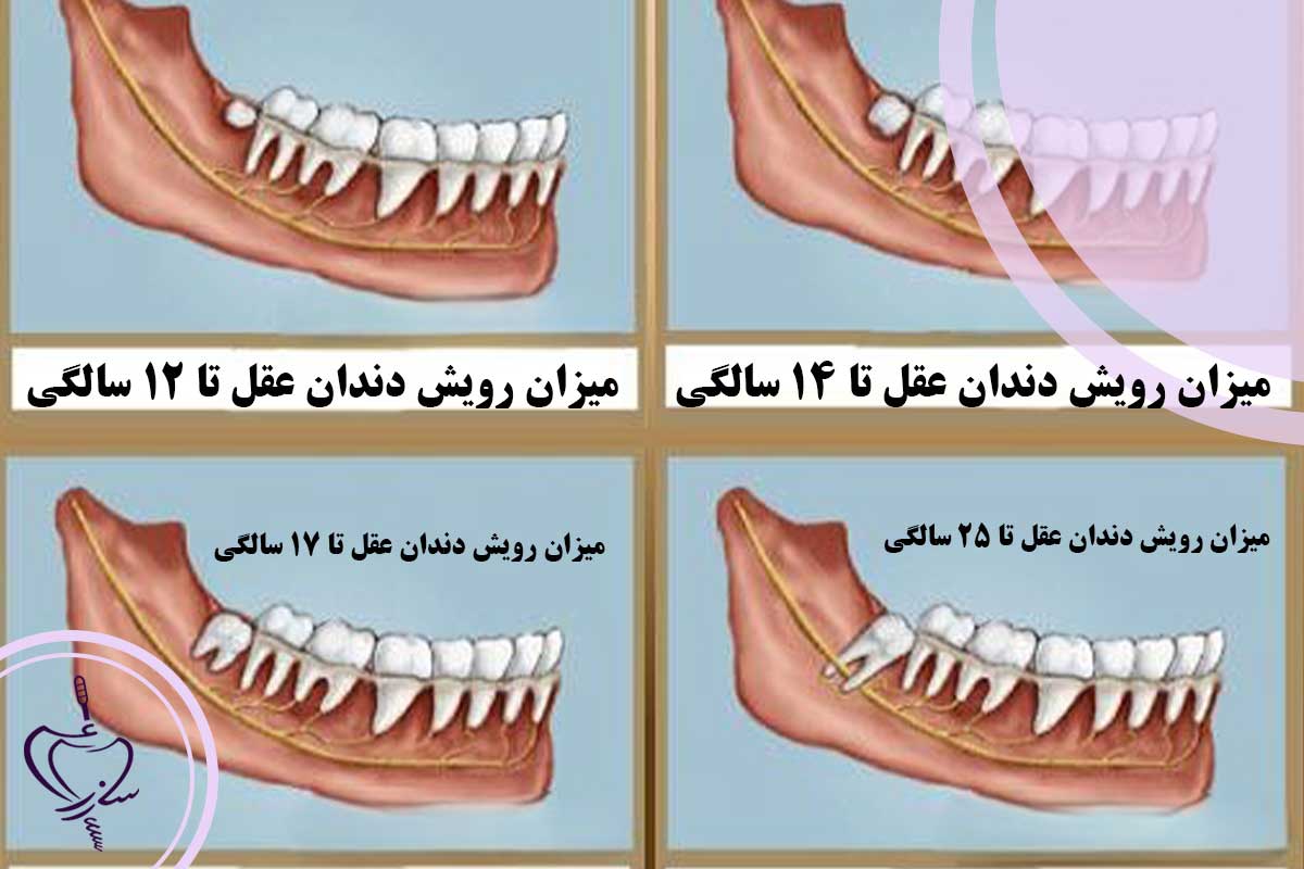 تقویم بیولوژیک: دندان عقل از چه سنی در میاد؟