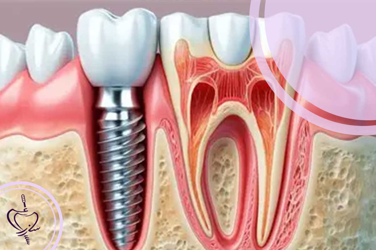 مقایسه برندهای ایمپلنت: آیا ایمپلنت ارزان، واقعاً ارزان‌تر تمام می‌شود؟