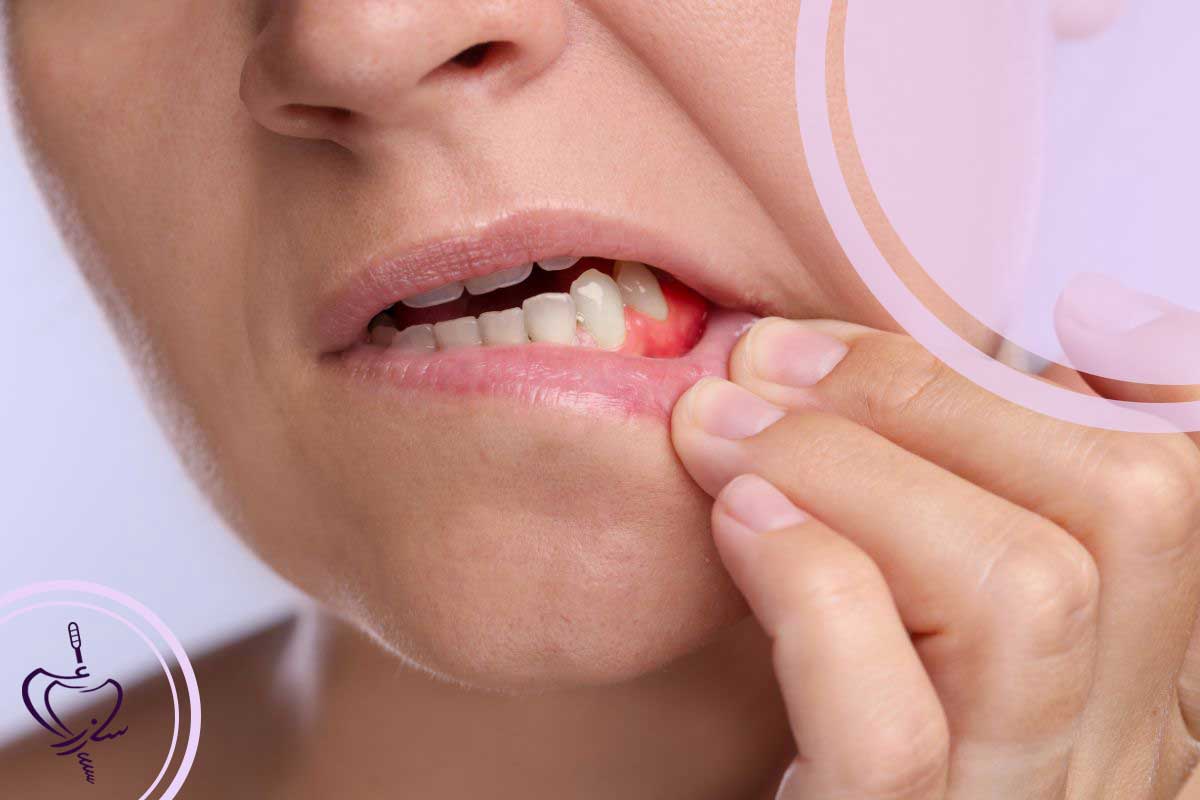 آناتومی یک شایعه: رفتار باکتری‌های پریودنتال در تبادل بزاق