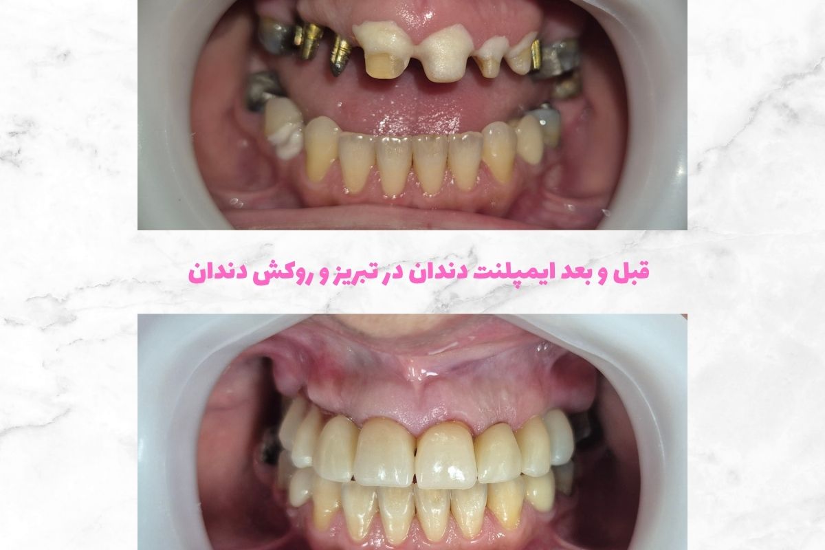 تصویر قبل و بعد ایمپلنت دندان در تبریز و روکش دندان