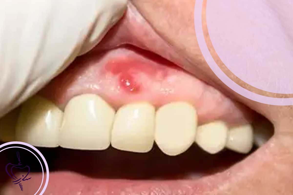 تحلیل مراحل عفونت لثه واگیردار و تأثیر آن بر طرح درمان ایمپلنت