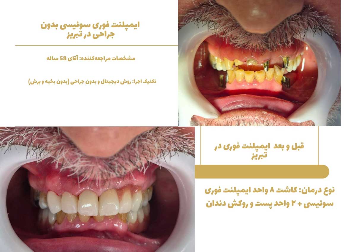 درمان ایمپلنت در دندانپزشکی بدون درد