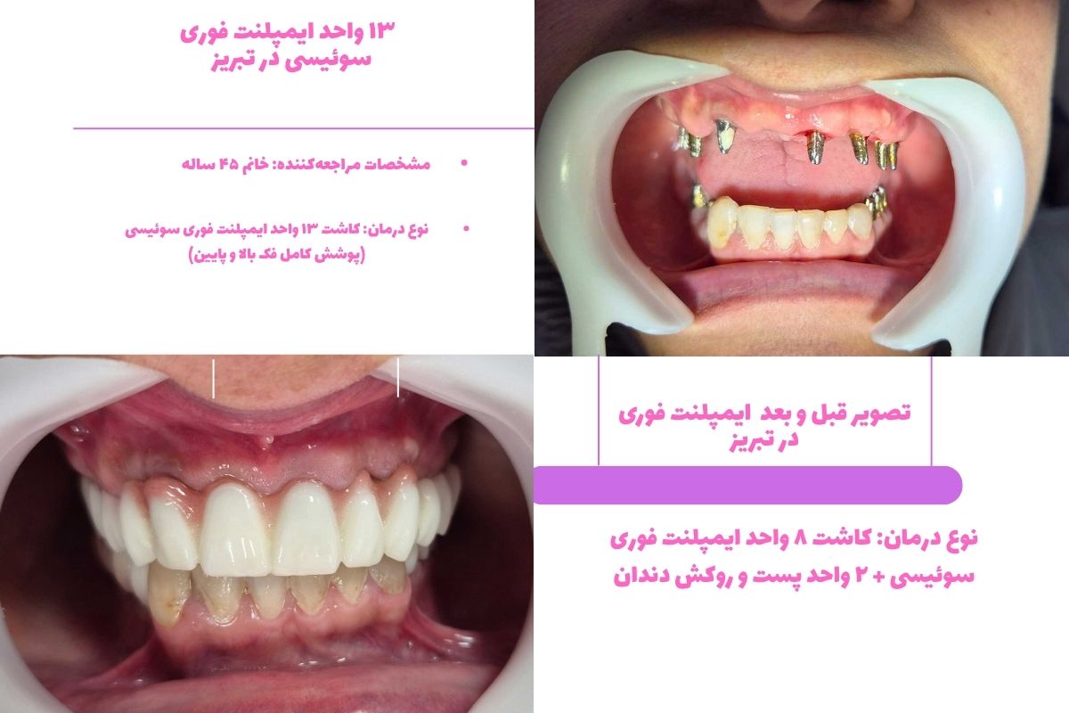 تصویر قبل و بعد ایم\لنت فوری در تبریز
