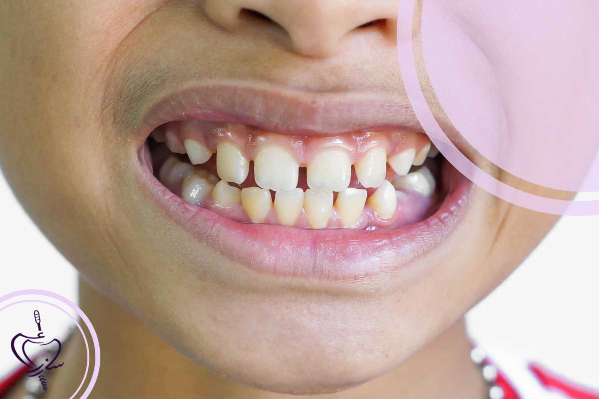 فاصله بین دندان جلو در کودکان