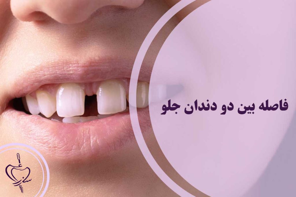 فاصله بین دو دندان جلو