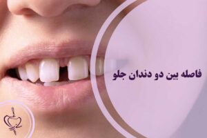 فاصله بین دو دندان جلو