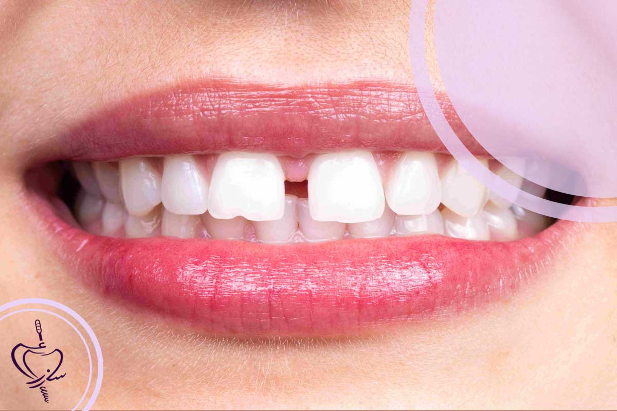 مقایسه روشهای بستن فاصله بین دندانهای جلو