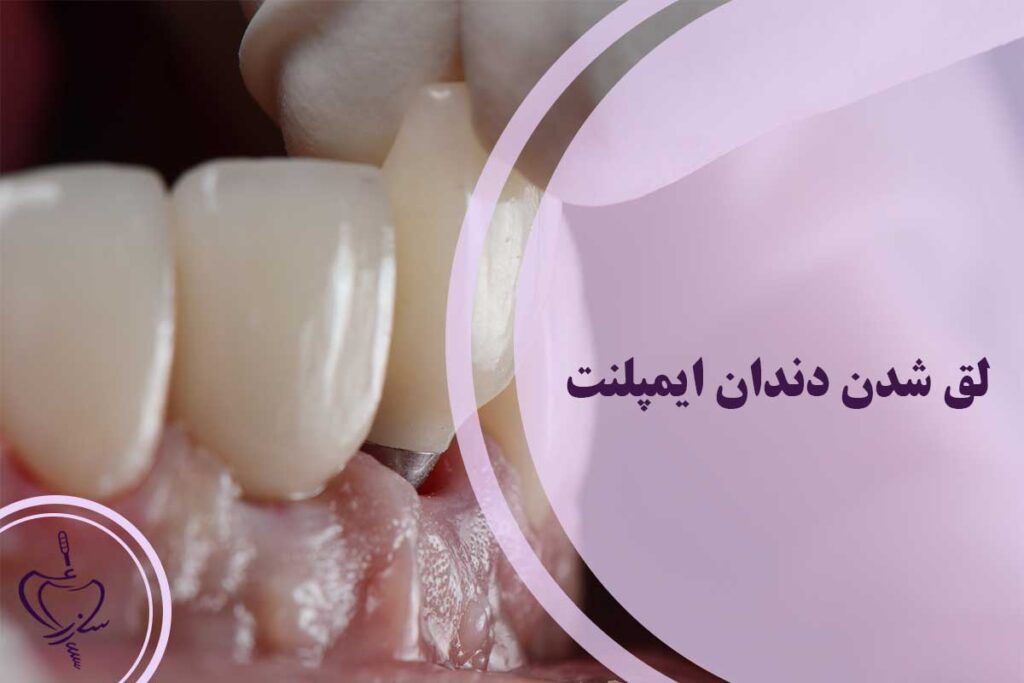 لق شدن دندان ایمپلنت