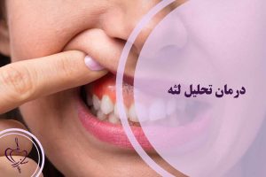 درمان تحلیل لثه