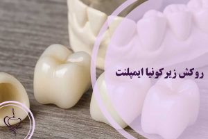 روکش زیرکونیا ایمپلنت