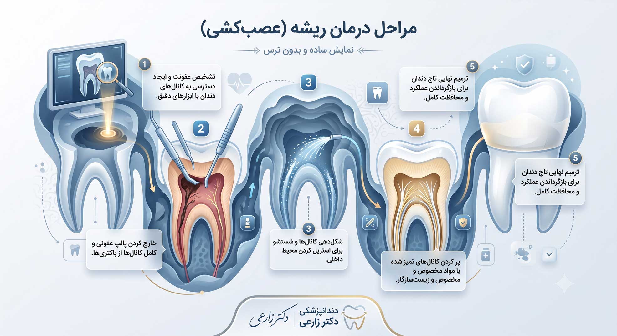 فرایند درمان کانال ریشه