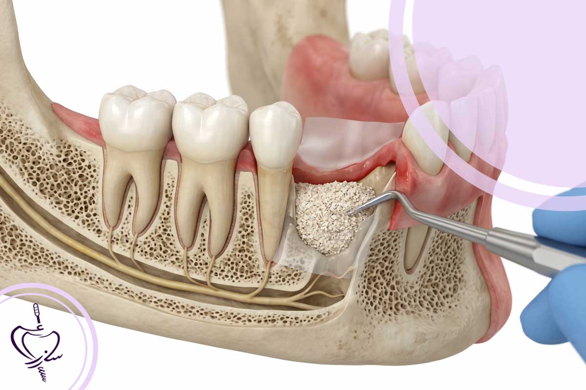 مقایسه روشهای رایج عریضسازی